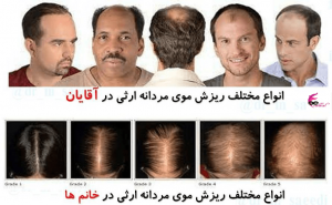 درمان ریزش موی ارثی